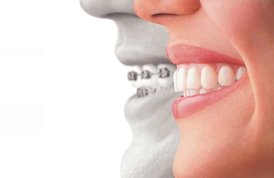 Invisalign difference